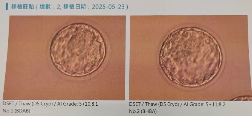 因子宮內膜癌中斷備孕  穩控病情求助名醫順產圓夢...